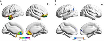 Structural and Functional Alterations of Substantia Nigra and Associations With Anxiety and Depressive Symptoms Following Traumatic Brain Injury